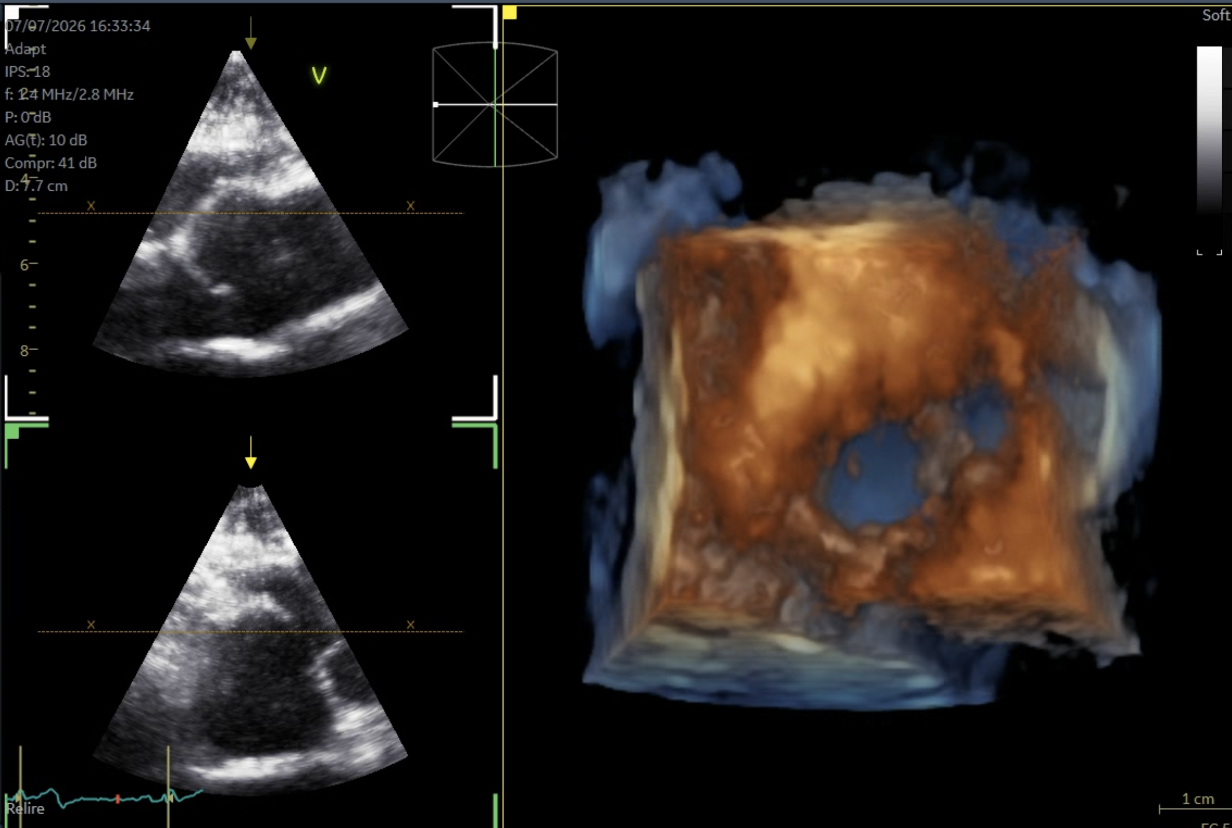 Requested 3D echocardiography acquisition